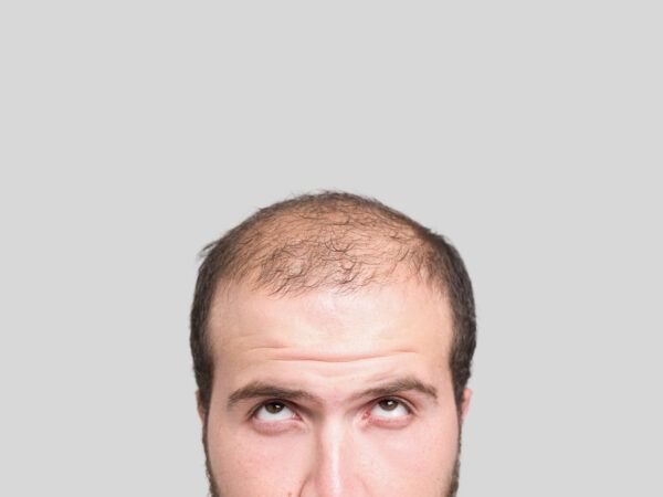 Hair Loss